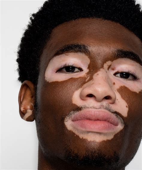 Vitiligo Images